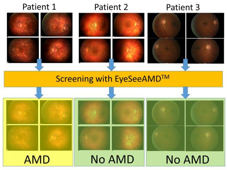 AMD_Screening_small AMD_Screening_small
