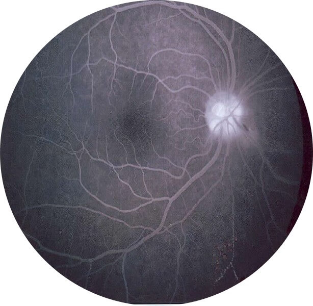 Fluorescein_angiography Fluorescein Angiography